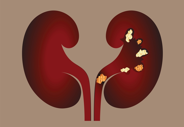Calculose - Urologia Eliseu Denadai - Clínica de Urologia em São José do Rio Preto/SP